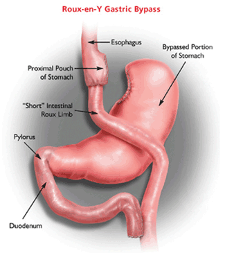 Decription of Roux-en-Y Gastric Bypass